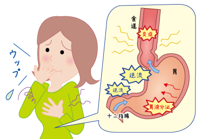 漢方DAYS★逆流性食道炎★埼玉中医薬研究会