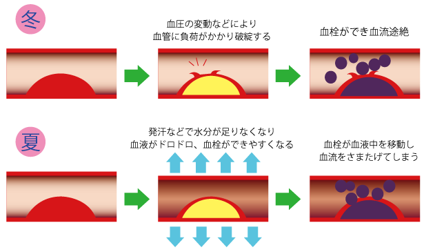 季節の漢方★夏の心筋梗塞★埼玉中医薬研究会