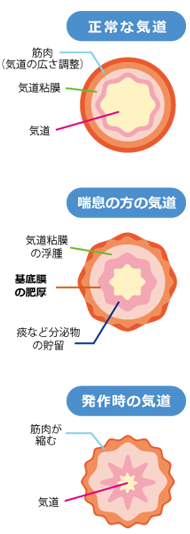 ぜんそく★漢方相談★埼玉中医薬研究会